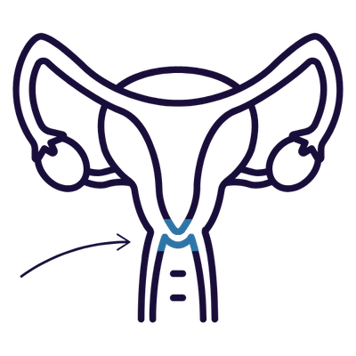 Diagram of the uterus, cervix in blue