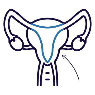 Diagram of the uterus, endometrium in blue