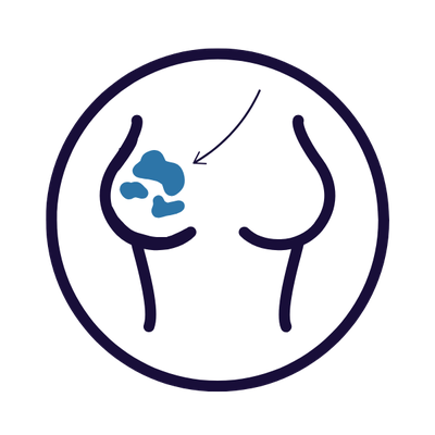 Diagram of a breast, tumour shown in blue