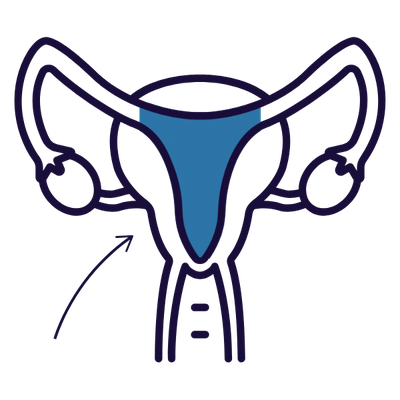 Diagram of the uterus, uterine body in blue