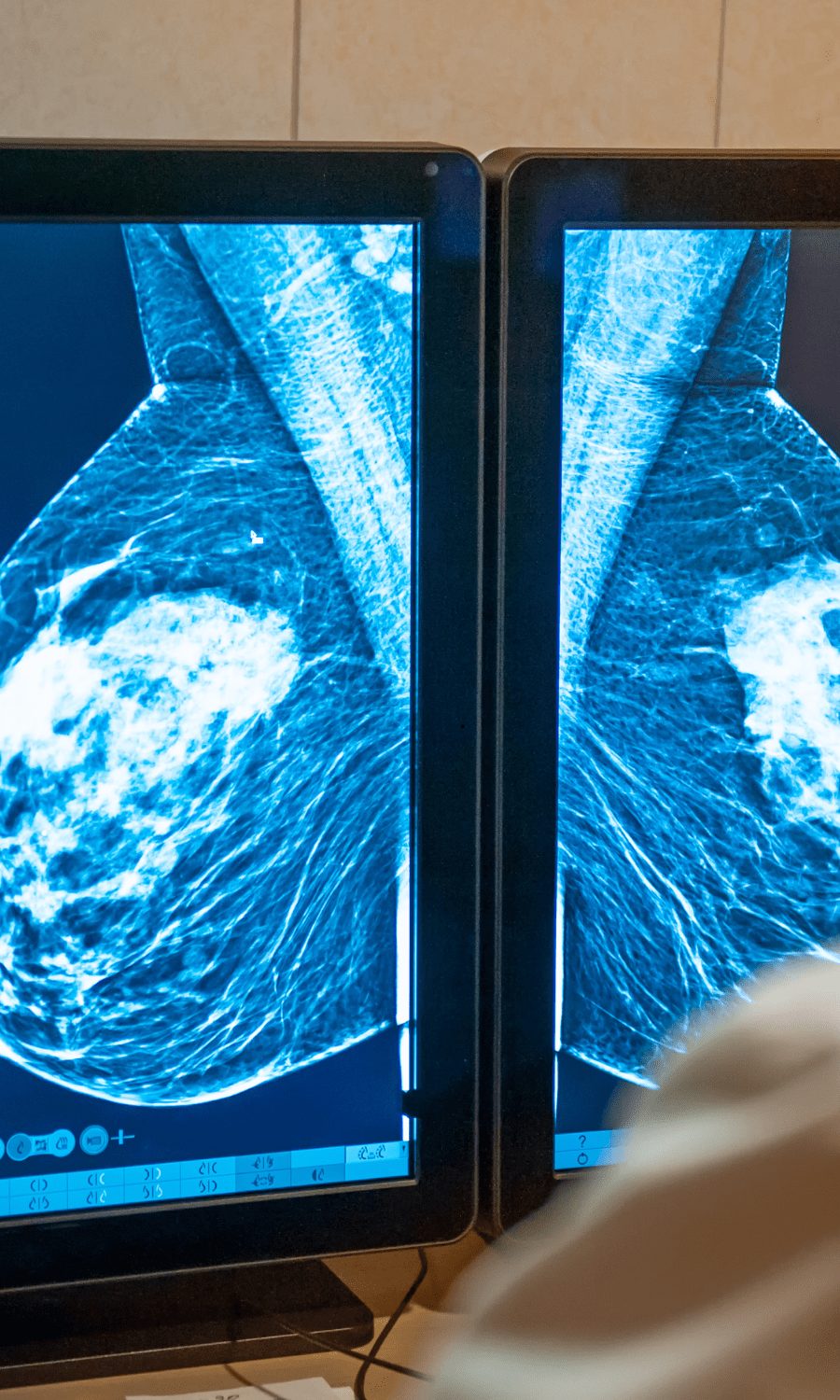 Mammography images displayed on two screens